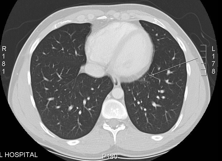 Pneumoconiosis