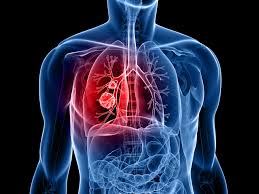 New Lung Cancer Drug Developed for Chinese Specific Treatment