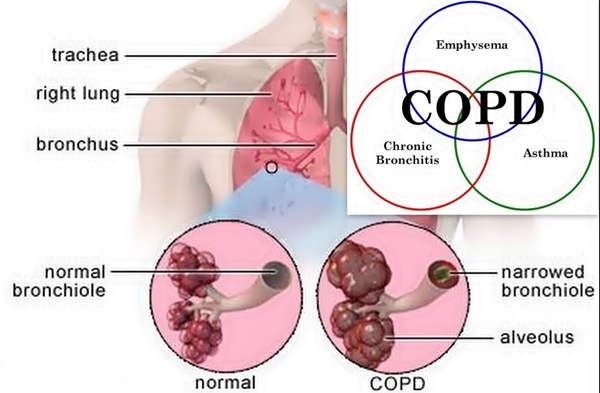 Smokers Have a 72% Chance of Getting Deadly Lung Disease